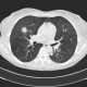 Wegener's granulomatosis, development in time, year two: CT - Computed tomography